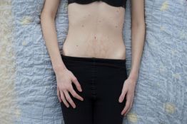 “I Want to Disappear” – Documenting Eating Disorders