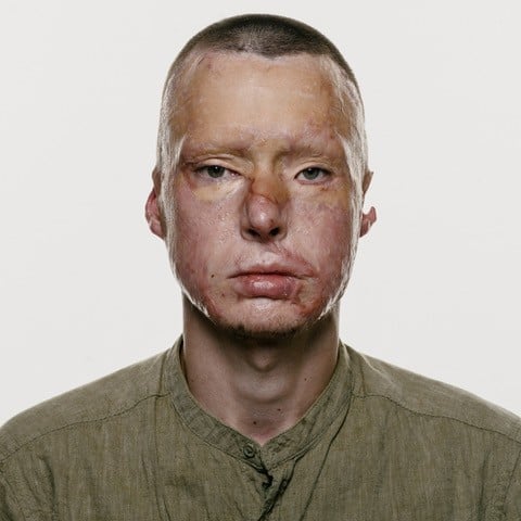 Images by photographer Giles Duley.