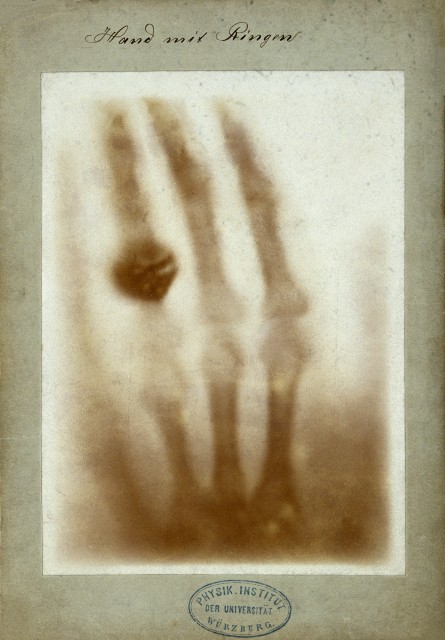 The first medical X-ray by Wilhelm R&ouml;ntgen, showing his wife Anna Bertha Ludwig's hand.
